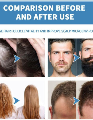 Minoxi Roll-on Hair Treatment, Hair Oil for Dry Damaged Hair and Growth ( Pack Of 2 )