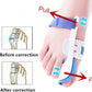 Foot Orthotic Bunion Splint Crooked  Thumb Corrector (1 Pair)